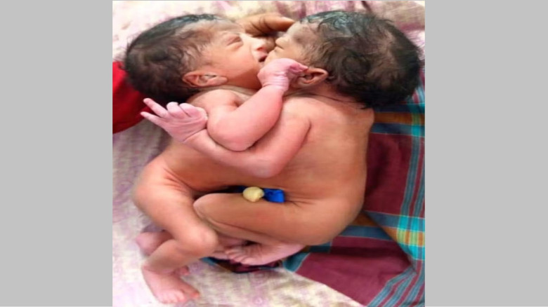 নওগাঁয় জোড়া লাগানো জমজ শিশুর জন্ম...