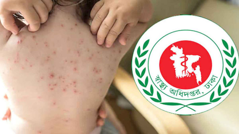 হাম ও হামের উপসর্গে ১০ জনের মৃত্যু, নতুন রোগী ১৪ শ...