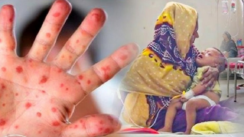 দেশে হাম ও উপসর্গ নিয়ে আরও ৫ জনের মৃত্যু...