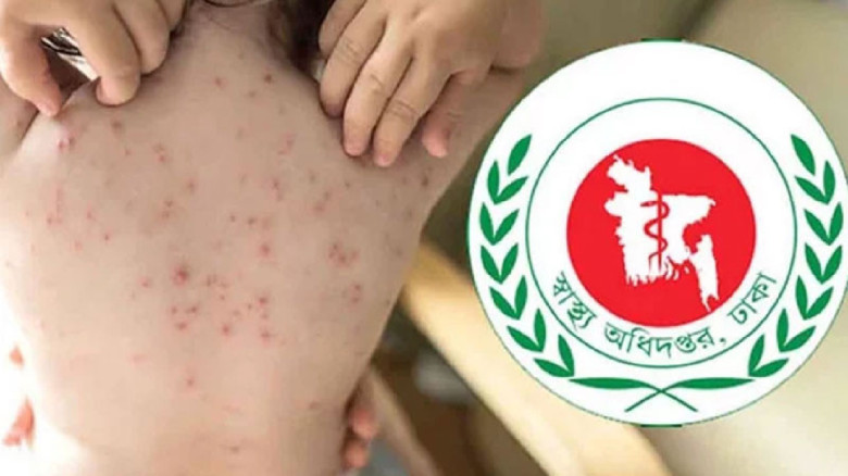 হামের উপসর্গ নিয়ে আরও নয়জনের মৃত্যু...