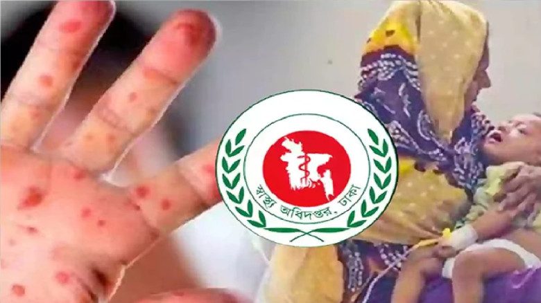 হামের উপসর্গ নিয়ে আরও ১১ শিশুর মৃত্যু...
