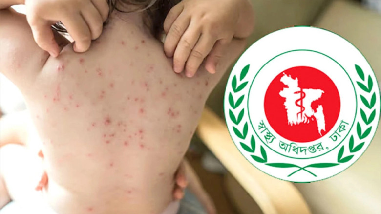 বিশ্বে হামে মৃত্যুতে শীর্ষে বাংলাদেশ...