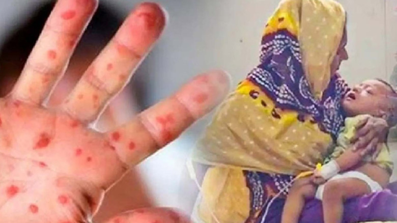 হাম ও উপসর্গ নিয়ে আরও চার শিশুর প্রাণহানি...