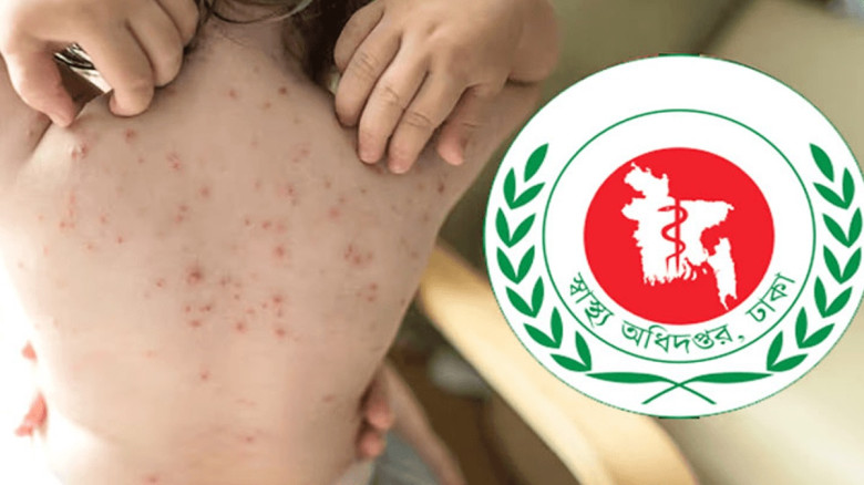 হামের উপসর্গ নিয়ে আরও তিন শিশুর মৃত্যু...