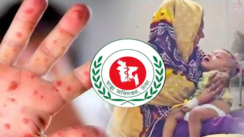হাম উপসর্গে আরও পাঁচ শিশুর মৃত্যু...
