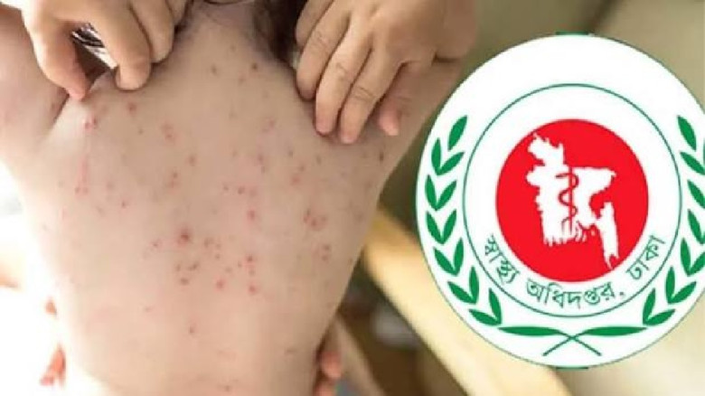 হামের উপসর্গ নিয়ে আরও ৩ শিশুর মৃত্যু...