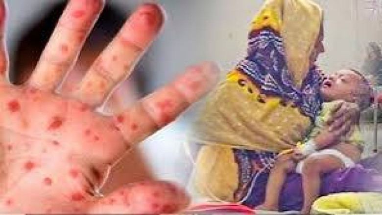 হাম ও উপসর্গে এখন পর্যন্ত ৭৮০ জনের মৃত্যু...