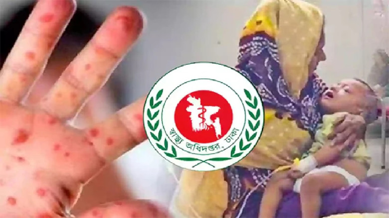 হামের উপসর্গ নিয়ে আরও ছয় শিশুর মৃত্যু...