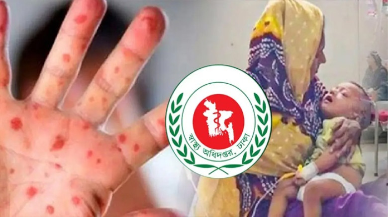 হামের উপসর্গ নিয়ে আরও চার শিশুর মৃত্যু